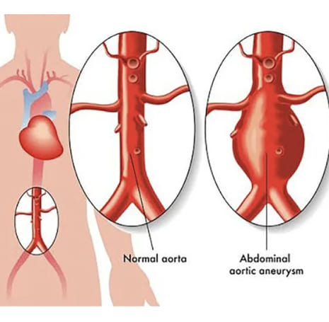 Cirugía endovascular para tratamiento de aneurismas de aorta abdominal y aneurismas de extremidades en la Roma