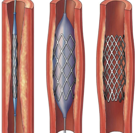 cirugía endovascular y abierta para enfermedad arterial periférica (angioplastías, colocación de stents, bypass) en la Roma