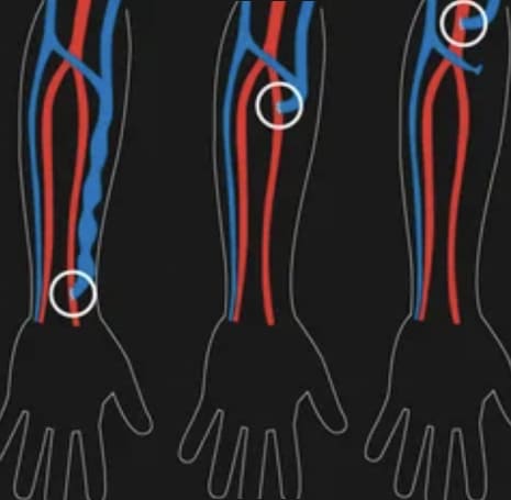 Escleroterapia en la Roma