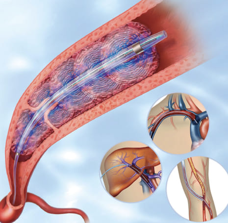 Tratamiento endovascular en la Roma